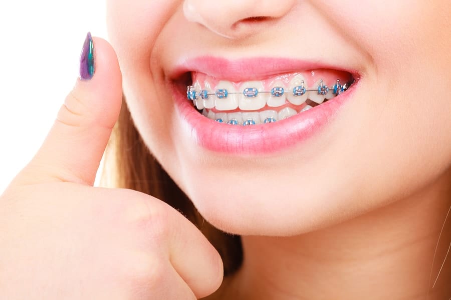 Girl With Braces