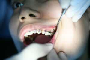 Person with silver braces