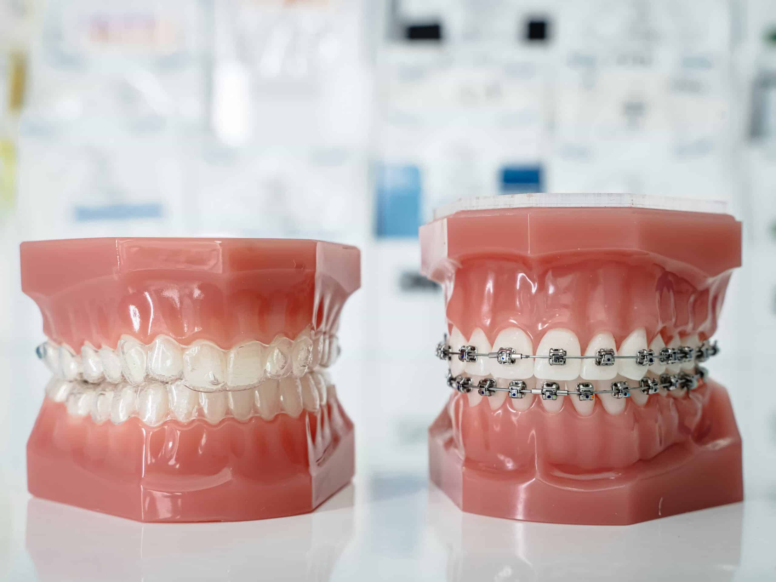 Helpful Fowler Orthodontics Tips & Info 98 Braces and invisalign on model teeth