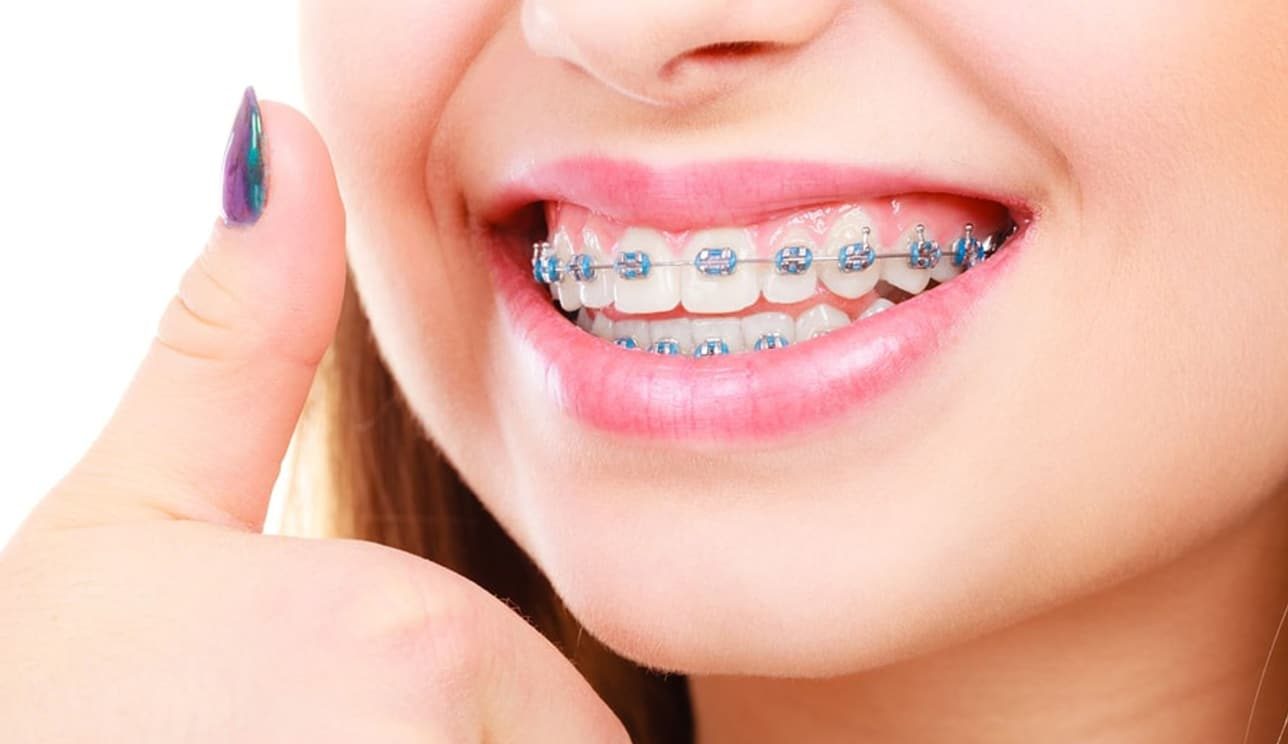 Traditional Braces